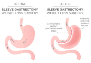 Vertical Sleeve Gastrectomy